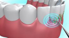 Dentapic Sonic - Systém čištění zubů